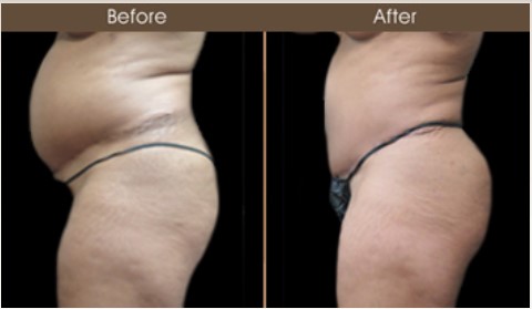 Gluteal Fat Transfer Treatment Results